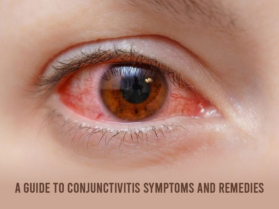 A closer look at Fiv Conjunctivitis Symptoms